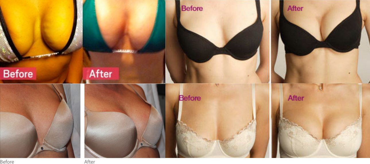 Breast Reduction And Lift 46