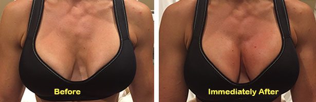 Vampire Breast Lift vs. Surgical Breast Lift - Heights Plastic Surgery